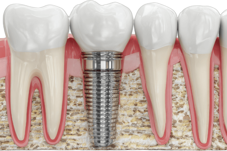 Implantaten Amsterdam Zuid